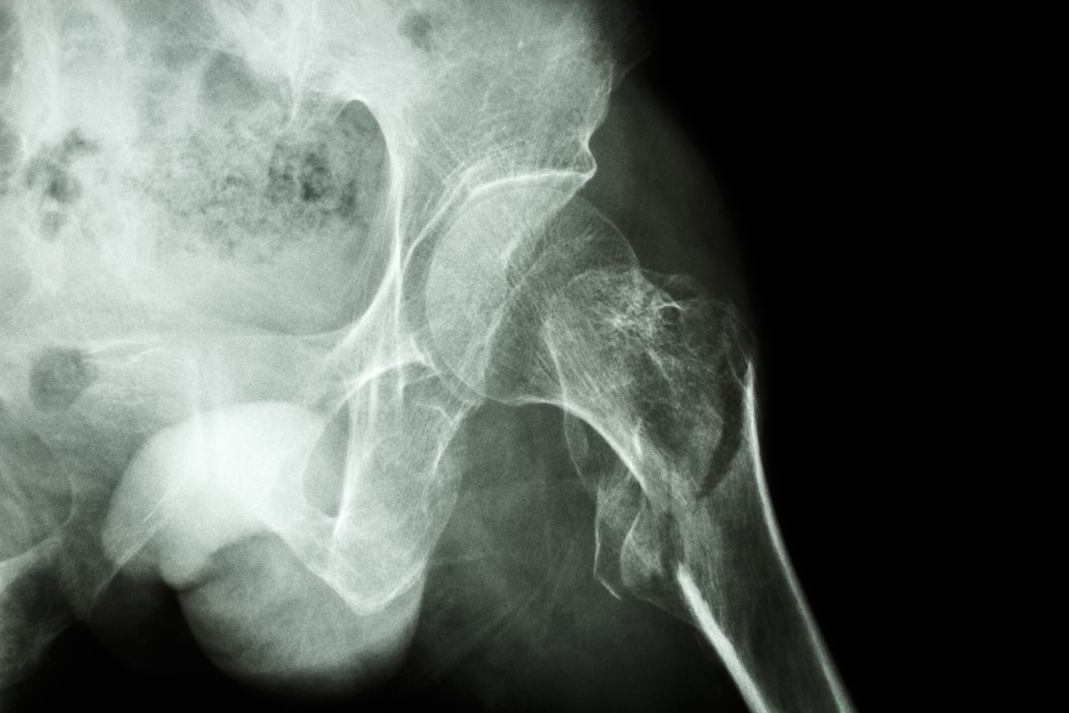 Gut-bone axis: Probiotic strain may boost bone measure in older women
