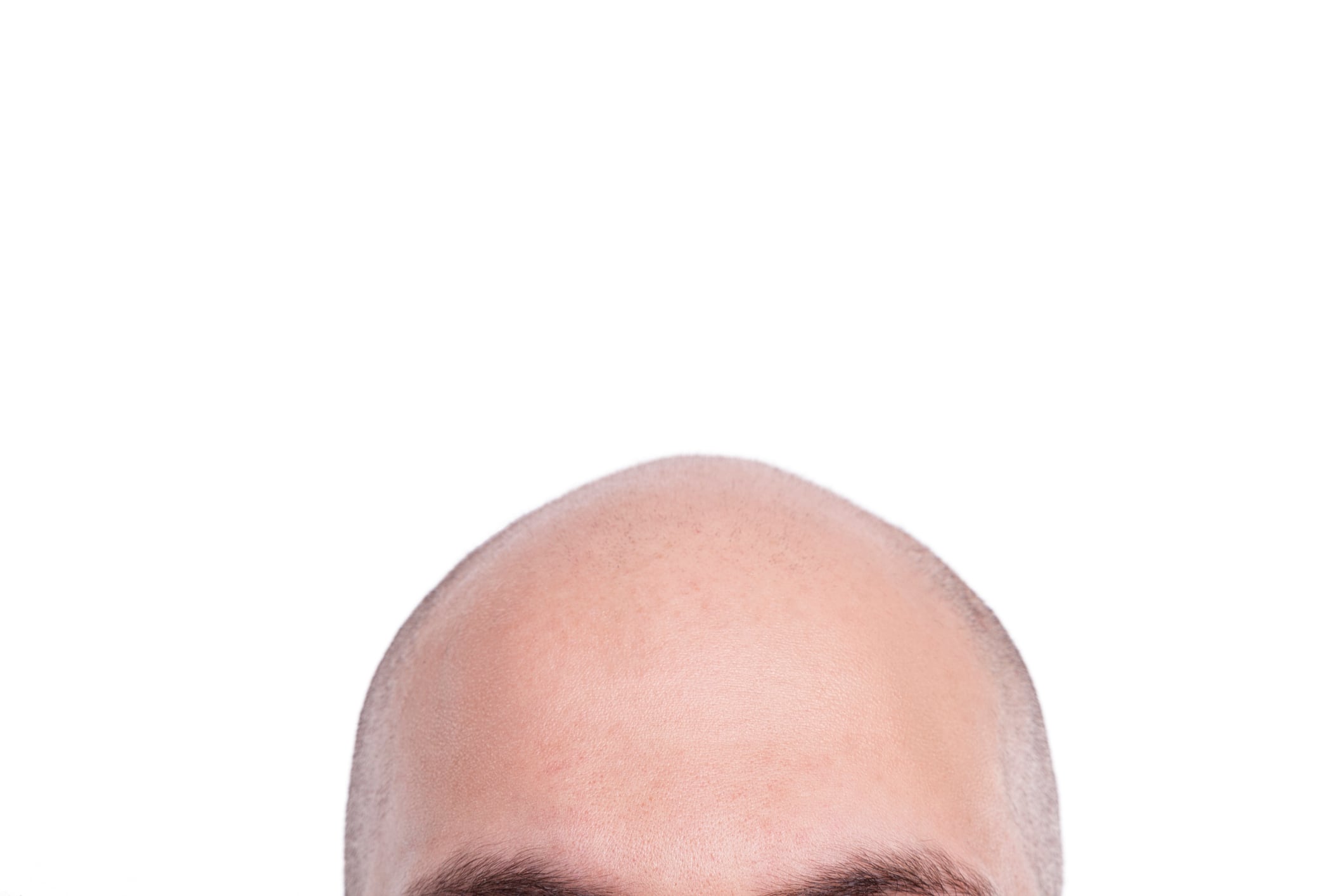 Sugary drinks linked to hair loss