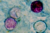 Four Cyclospora oocysts from fresh stool stained using a modified acid-fast stain. Picture copyright: CDC (DPDx).