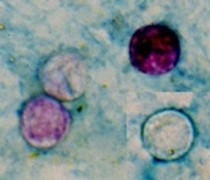 Source unknown as cyclospora case count grows. Four Cyclospora oocysts from fresh stool stained using a modified acid-fast stain. Picture copyright: CDC (DPDx).