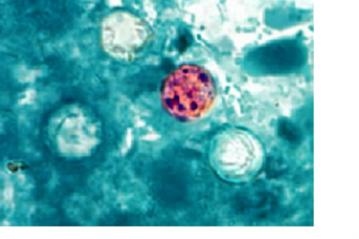 Picture: CDC. Oocysts of C. cayetanensis stained with modified acid-fast stain