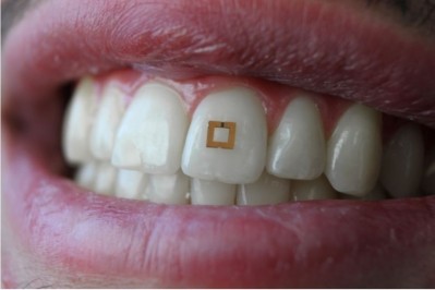 A miniaturised sensor mounted on a tooth. ©SilkLab, Tufts University. 